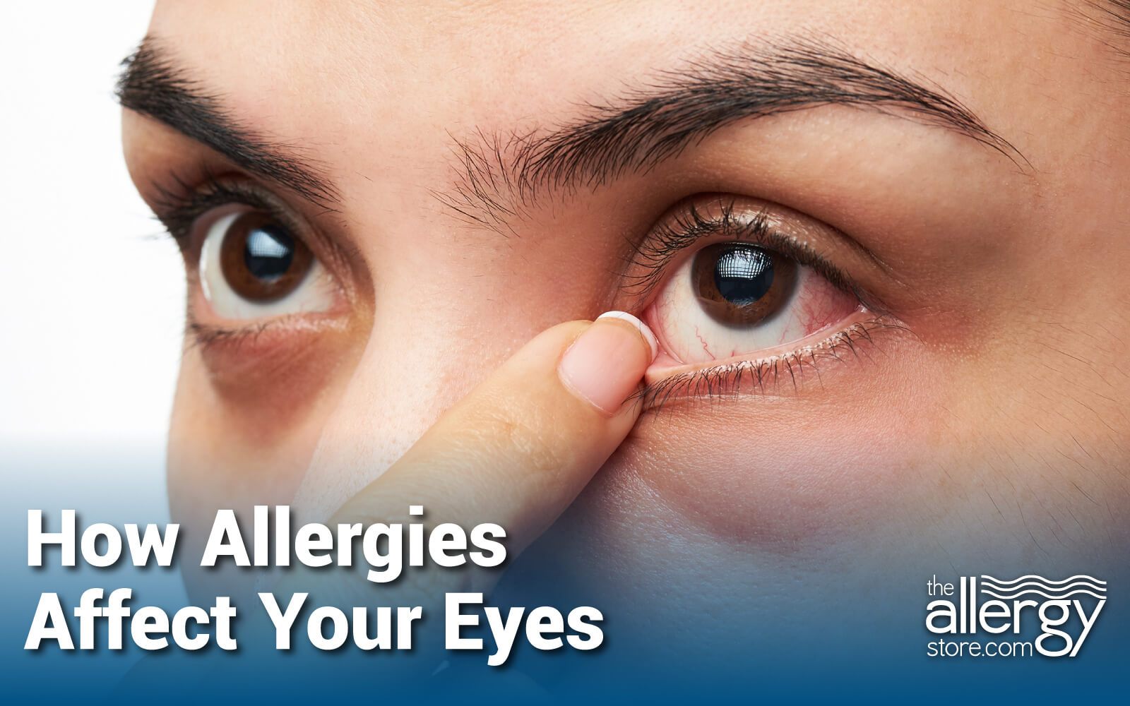 Vibrant Eye Swelling Due To Allergies Artwork for Mobile Vibrant Eye Swelling Due To Allergies Artwork for Mobile